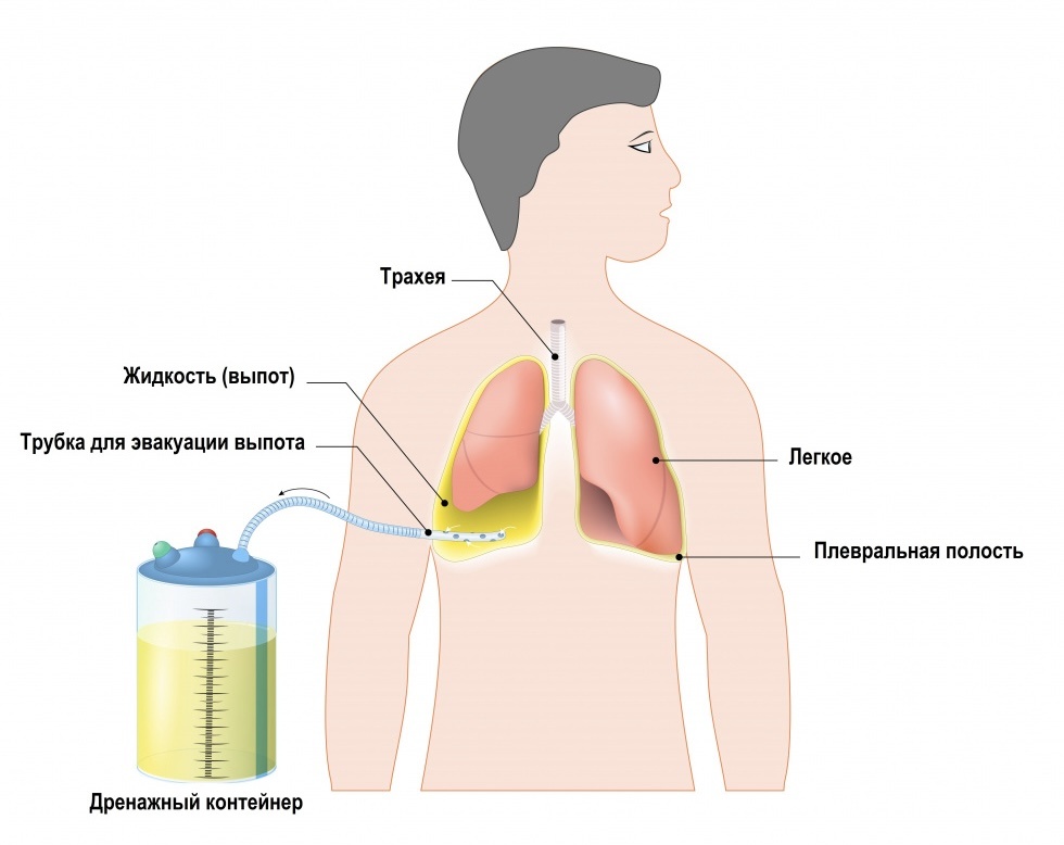 Дренирование плевральной полости