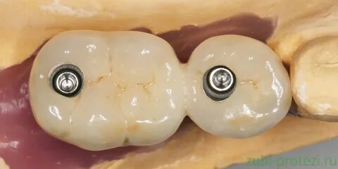 Шахта для винтового крепления в коронках на имплантатах