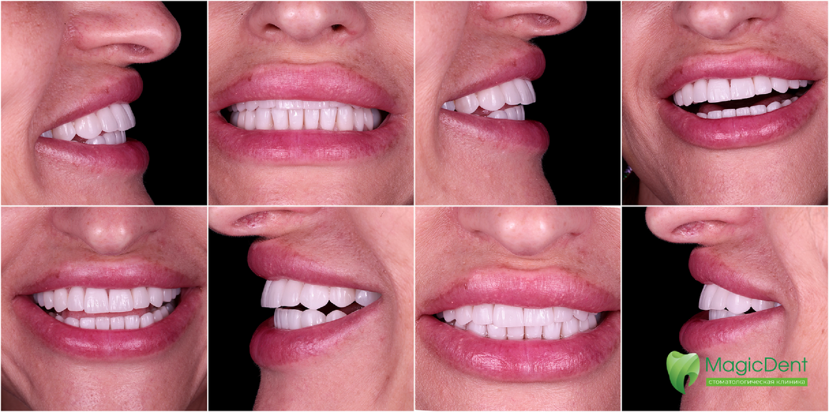 Тотальная реконструкция улыбки у пациентки 53-х лет. Кeрамические вниры E.Max. Работа врача стоматолога-ортопеда, Завена Ашотовича Терзяна