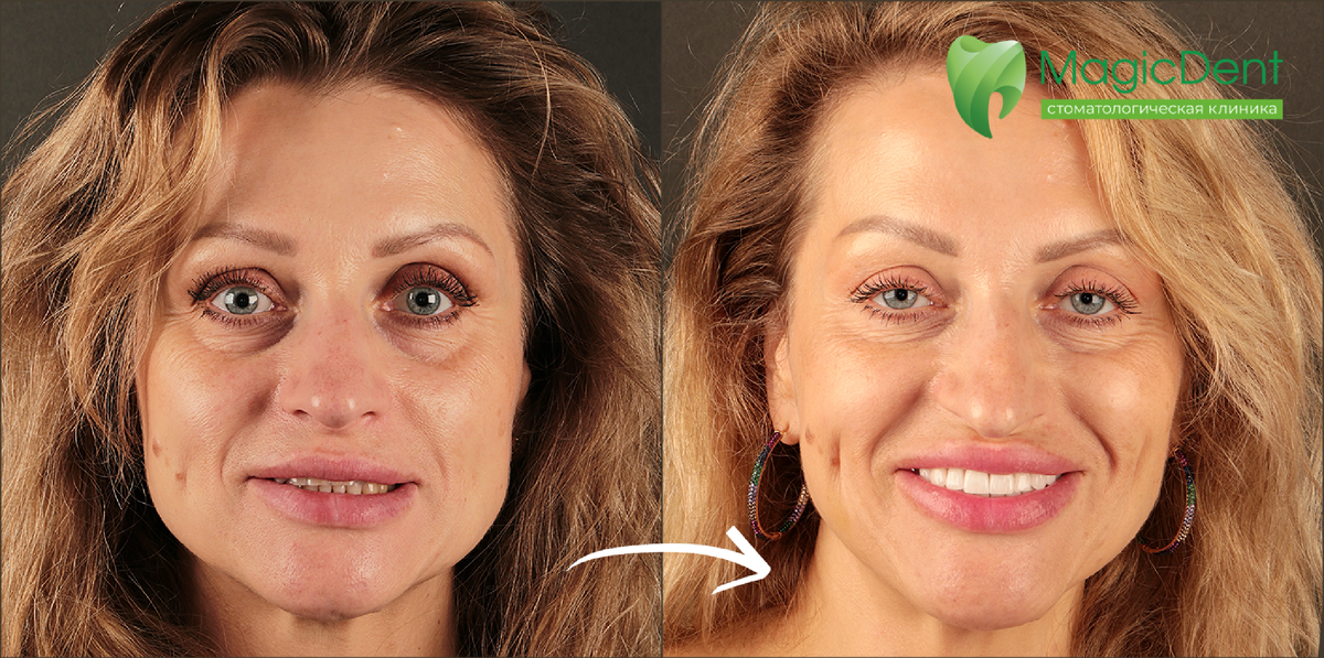 Преображение прекрасной пациентки 53-х лет, виниры E.Max