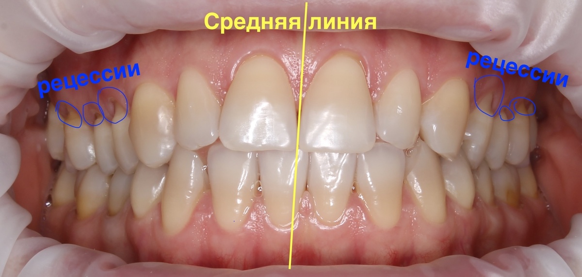 Рецессии зубов верхней челюсти 