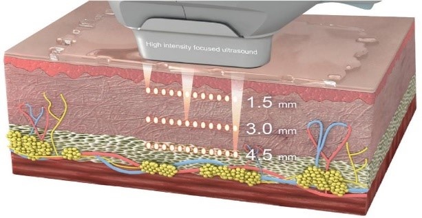 Микро- и макрофокус дают возможность выполнять разные задачи:
1.Контролируемый нагрев структур кожи с целью лифтинга и омоложения.
2.Повреждение подкожной жировой клетчатки с целью контролируемого уменьшения объемов через разрушение жировых клеток;