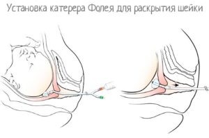 как ускорить раскрытие шейки матки перед родами