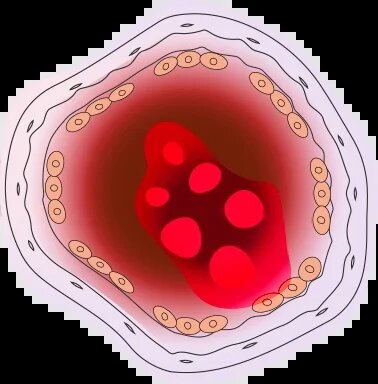 Сосуд в тонусе 