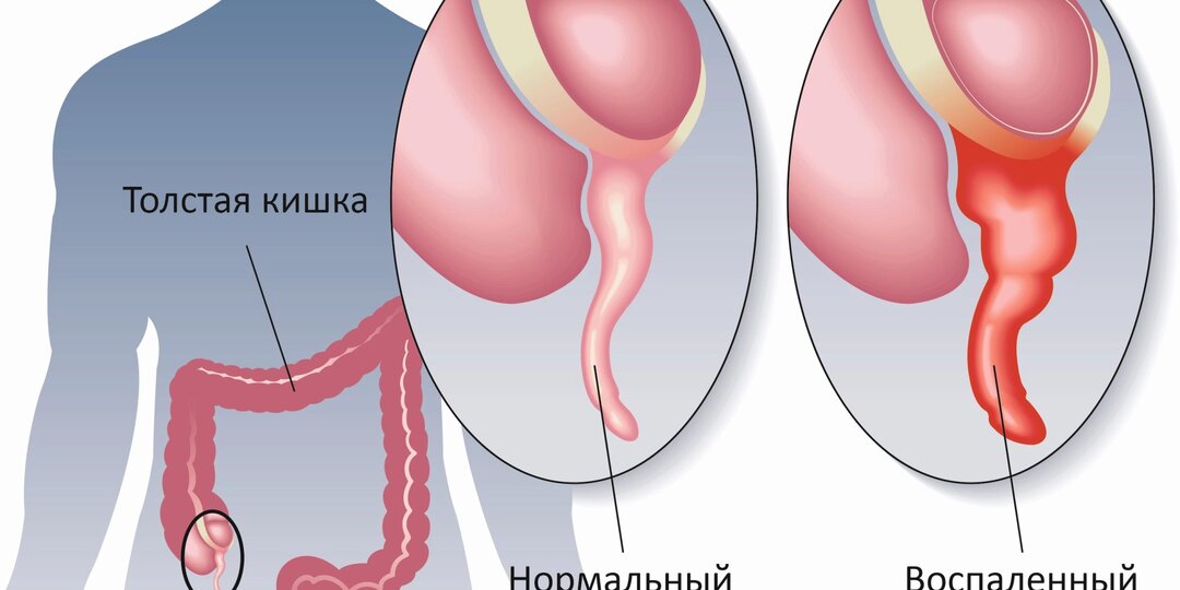 Аппендикс: удалять или спасать? Новые данные заставляют задуматься