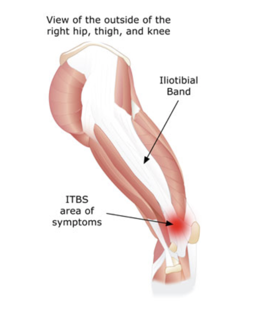Синдром илиотибиального тракта (ИТ)