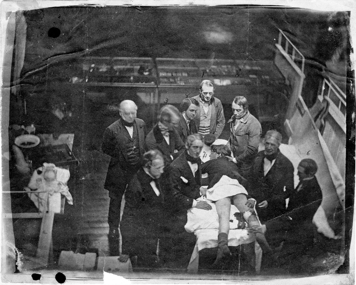 Пациентке под воздействием эфира, первого анестетика, удаляют ногу.