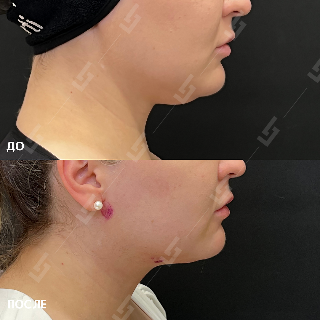 Результат через 7 дней после процедуры