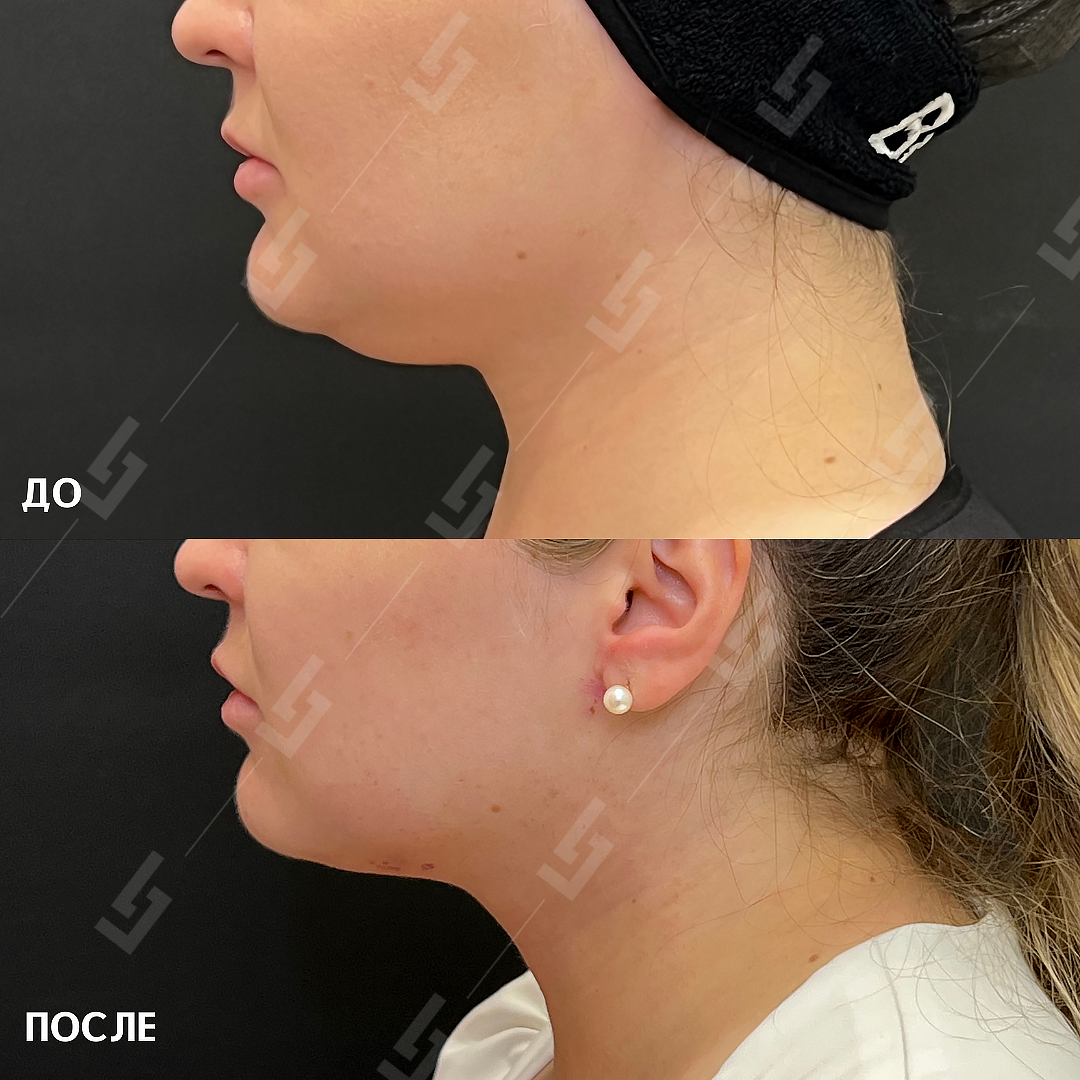 Результат через 7 дней после процедуры