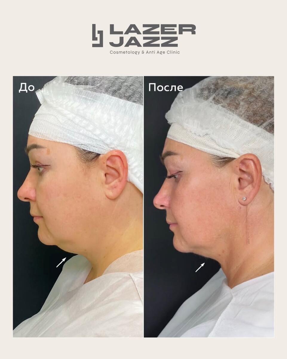 Процудурв FaceTite - удаление второго подборока