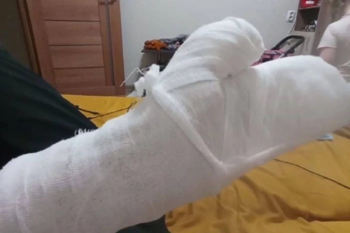    В Ростове женщина получила ожоги и перелом от взрыва «волшебной палочки»