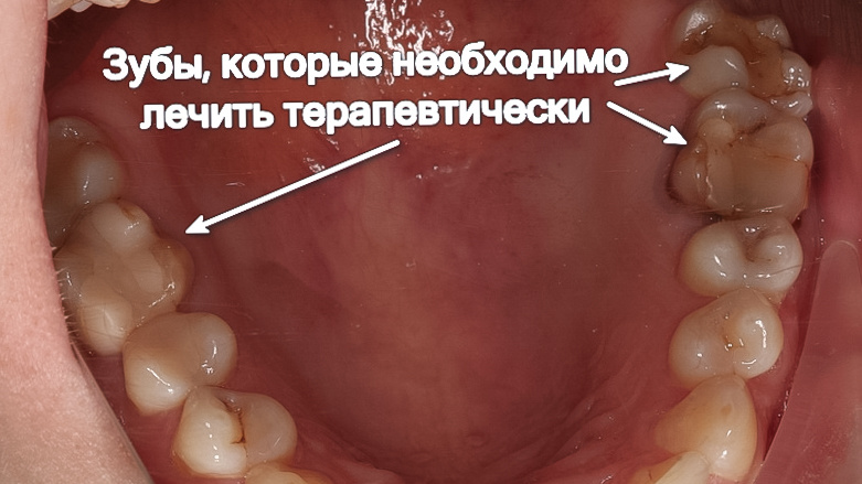Зубы, которые необходимо восстанавливать пломбами