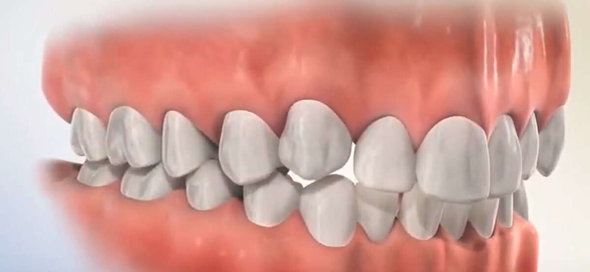 Неправильный прикус реально снижает качество жизни, влияя на здоровье