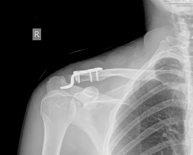 На рисунке 1 приведено устройство для остеосинтеза переломов акромиального конца ключицы, где: 1 - пластина, 2 - паз комбинированного отверстия для блокирования пластины блокирующими винтами, 3 - паз комбинированного отверстия для компрессии отломков кортикальными винтами, 4 - отверстие для фиксации отломков в дистальной части ключицы кортикальным винтом, 5 - выемки, 6 - фиксирующий узел в виде вилки, состоящей из двух зубцов, 7 - шипы, 8 - кортикальные винты, 9 - блокирующие винты (общий вид, аксонометрическая проекция); на фиг.2 - устройство для остеосинтеза переломов акромиального конца ключицы, где: 1 - пластина, 2 - паз комбинированного отверстия для блокирования пластины блокирующими винтами, 3 - паз комбинированного отверстия для компрессии отломков кортикальными винтами, 4 - отверстие для фиксации отломков в дистальной части ключицы кортикальным винтом, 5 - выемки, 6 - фиксирующий узел в виде вилки, состоящей из двух зубцов, 7 - шипы (вид сверху); на фиг.3 - устройство для остеосинтеза переломов акромиального конца ключицы, где: 1 - пластина, 2 - паз комбинированного отверстия для блокирования пластины блокирующими винтами, 3 - паз комбинированного отверстия для компрессии отломков кортикальными винтами, 4 - отверстие для фиксации отломков в дистальной части ключицы кортикальным винтом, 5 - выемки, 6 - фиксирующий узел в виде вилки, состоящей из двух зубцов, 7 - шипы (вид сбоку); на фиг. 4 - устройство для остеосинтеза переломов акромиального конца ключицы, где: 1 - пластина, 6 - фиксирующий узел в виде вилки, состоящей из двух зубцов, 7 - шипы (вид спереди); на фиг.5 - устройство для остеосинтеза переломов акромиального конца ключицы, где: 8 - кортикальный винт, 9 - блокирующий винт (вид спереди).