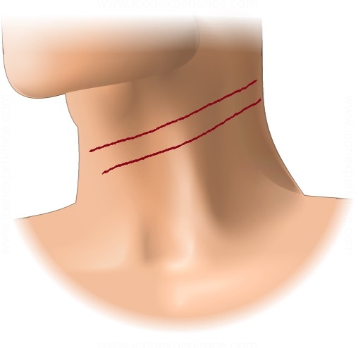 Вот такого размера полосы она мне тогда оставила