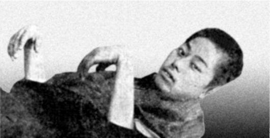 Паралич кисти при бери-бери (по R. Berg, 1927)