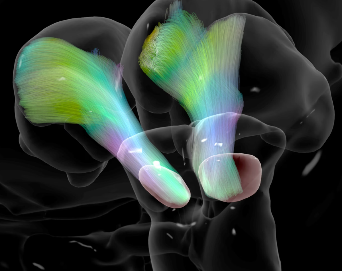 Это МРТ-сканирование показывает нервные волокна, окрашенные в красный, зеленый и синий цвета, в области мозга, участвующей в контроле гладких мышц. При болезни Паркинсона разрушение этих нейронов снижает количество дофамина в этой области мозга, что приводит к тремору, судорожным движениям и отсутствию координации.