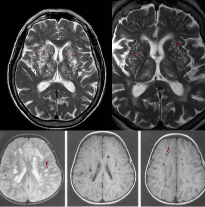 На МРТ в режиме Т1- и Т2-ВИ расширенные периваскулярные пространства определяются на аксиальных сканах в виде округлых образований с четкими ровными контурами, расположенными по ходу перфорирующих сосудов, по характеристикам сигнала соответствуют сигналу от ликвора. Отсутствует контрастное усиление, нет кальцинатов и перифокального отека в прилежащих отделах головного мозга