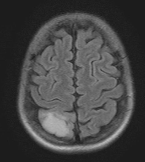МРТ головного мозга -очаг ишемии в ПСМА с отёком 29х20 мм