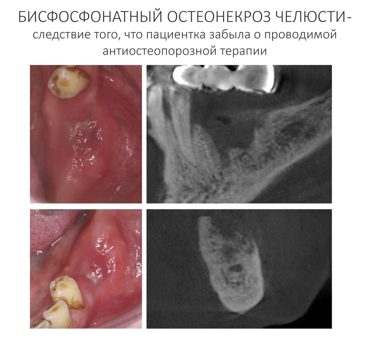 Пациентка 80 лет забыла сообщить стоматологу-хирургу, что проходит антиостеопорозную терапию бисфосфонатами. Как результат — развившийся после удаления зуба хронический остеомиелит (бисфосфонатный остеонекроз) нижней челюсти, с которым не могут справиться несколько месяцев:Неоднократная секвестрэктомия не приводит к улучшению состояния, что для 80-летней женщины весьма критично. Хотя, предотвратить подобное развитие событий очень легко — достаточно вспомнить и рассказать доктору обо всех проблемах со здоровьем.