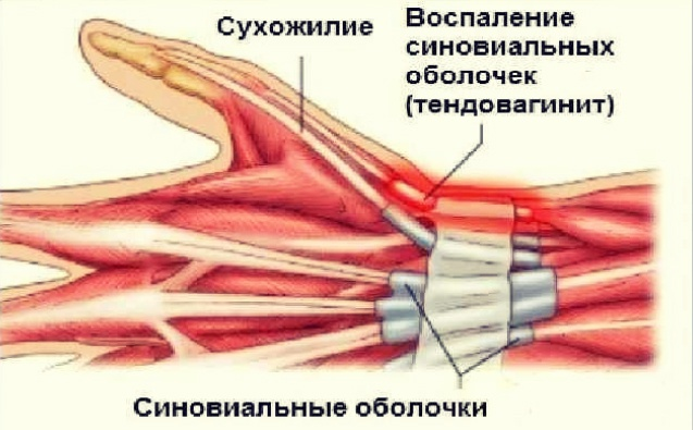 Что это такое, я догадался быстро: крепитирующий тендовагинит. 