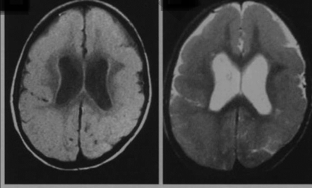 Пример лиссэнцефалии на МРТ: широкие и плоские извилины с мелкими единичными бороздами в лобных долях, а также в теменно-затылочных областях. Боковые желудочки расширены, белое вещество слабо развито.