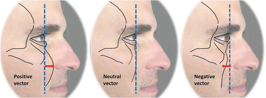 Орбитальный вектор. Источник - https://www.researchgate.net/figure/Facial-vector-types-The-vector-defining-the-relationship-between-the-anterior-corneal_fig2_364269683