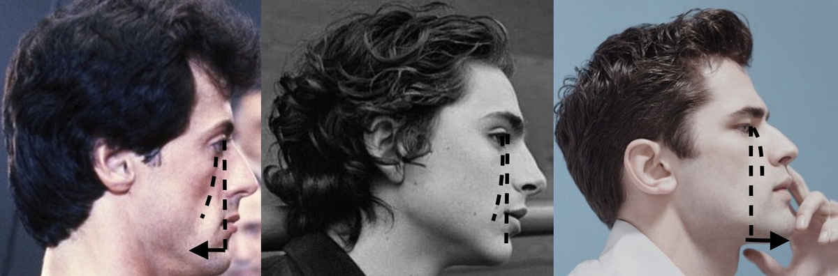 Негативный орбитальный вектор, нейтральный и позитивный. Определяет, насколько развита кость верхней челюсти и выдвинута вперед. Позитивный вектор считается наиболее привлекательным