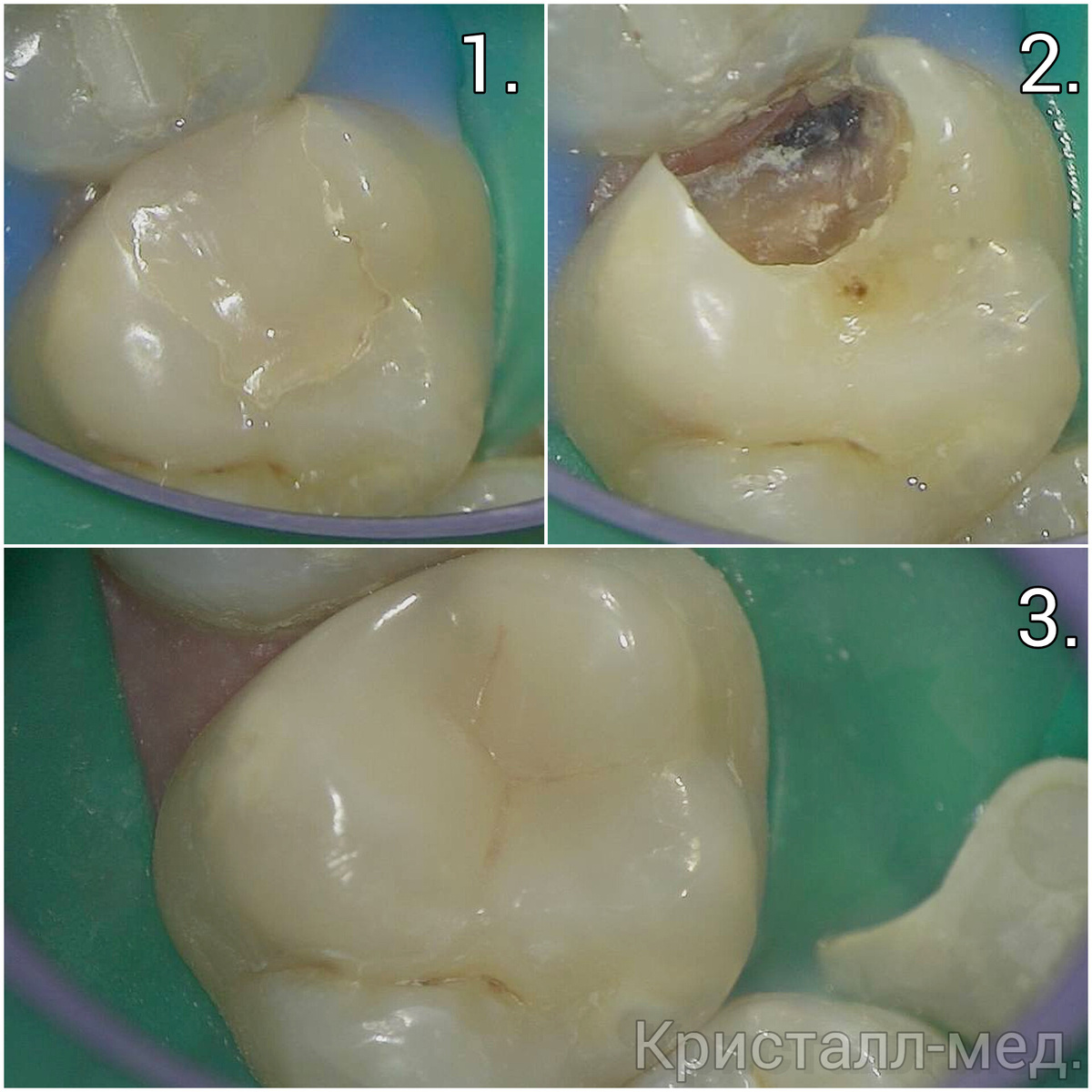 Лечение в "Кристалл-мед". 