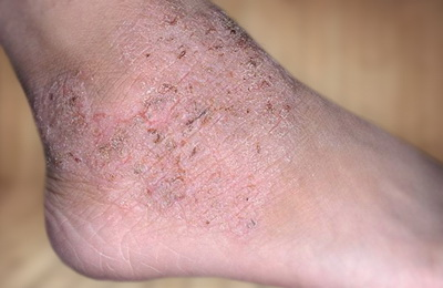 Дерматит на ноге