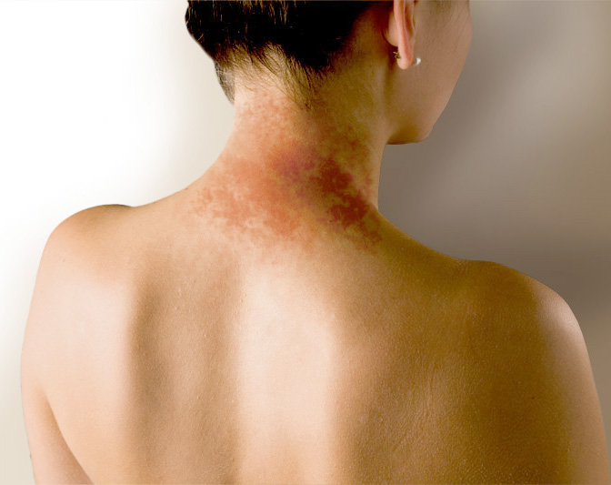 дерматит на шее от колье 