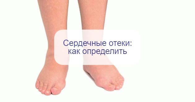 Отекают руки и ноги – как понять, что это «сердечные» отеки и чем они отличаются от «почечных»