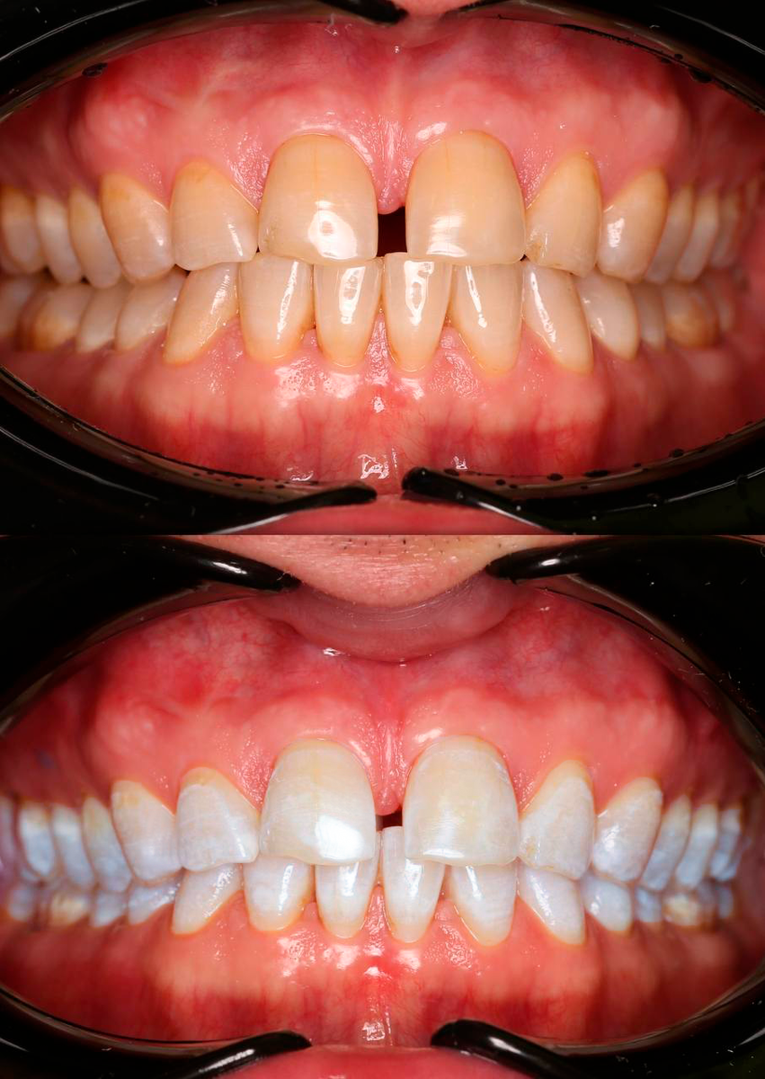 Результат лазерного отбеливания стоматолога- терапевта клиники "Династия Н" Ольги Игоревны Конченковой