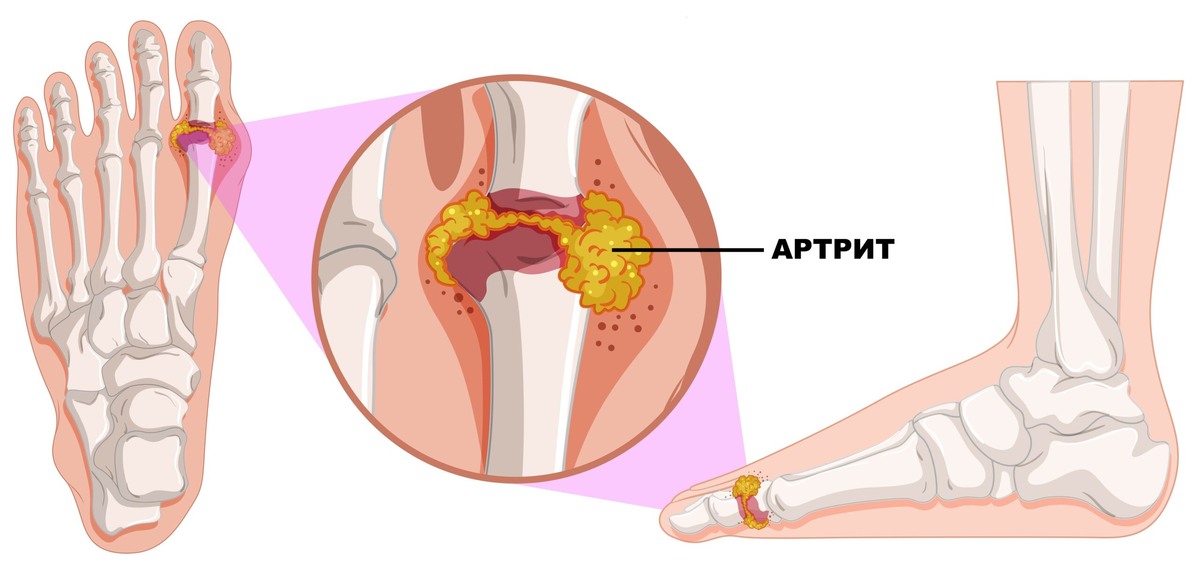    Что есть и чего избегать: рыба при подагре