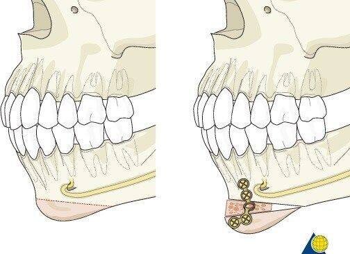 Так выглядит подбородок после пластики
