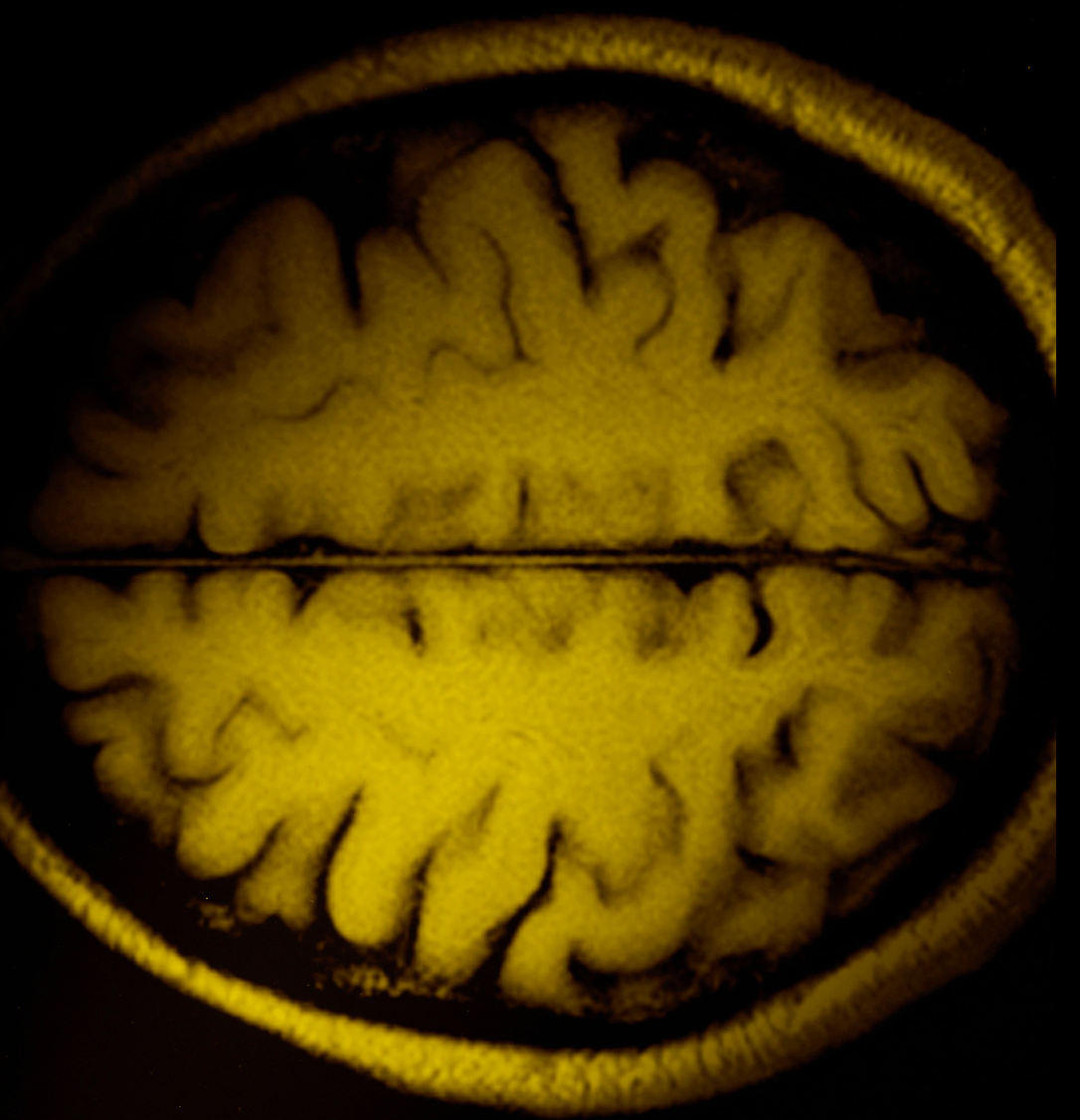 Исследователи из Стэнфорда недавно описали шесть различных «биотипов» депрессии. Опубликованная в журнале Nature Medicine, команда сообщает о паттернах мозговой активности, уникальных для каждого типа, поведенческих характеристиках и потенциале для индивидуального лечения на основе этих наблюдений.