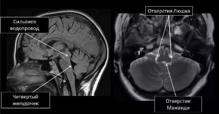 Отверстия Люшка и Мажанди - это отверстия в полости IV желудочка мозга, через которые имеется сообщение ликвора с субарахноидальным пространством. Отверстие Монро соединяет каждый боковой желудочек с III