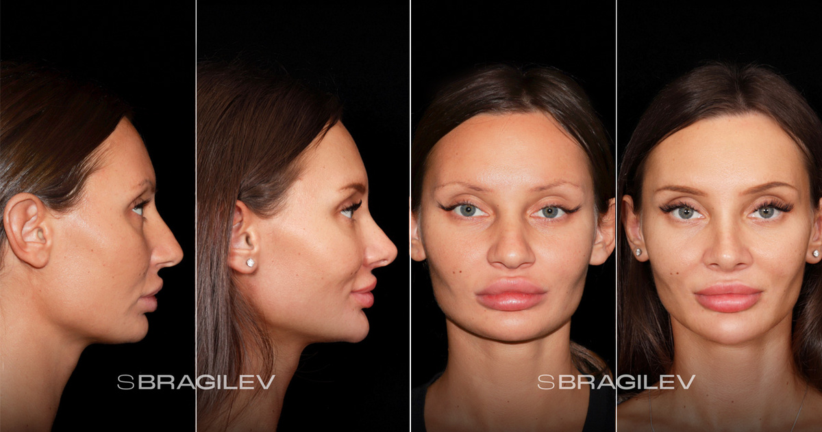 до и после сохраняющей ринопластики 