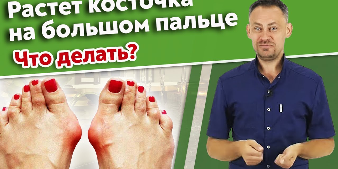 Почему торчат косточки на пальцах ног - Hallux valgus