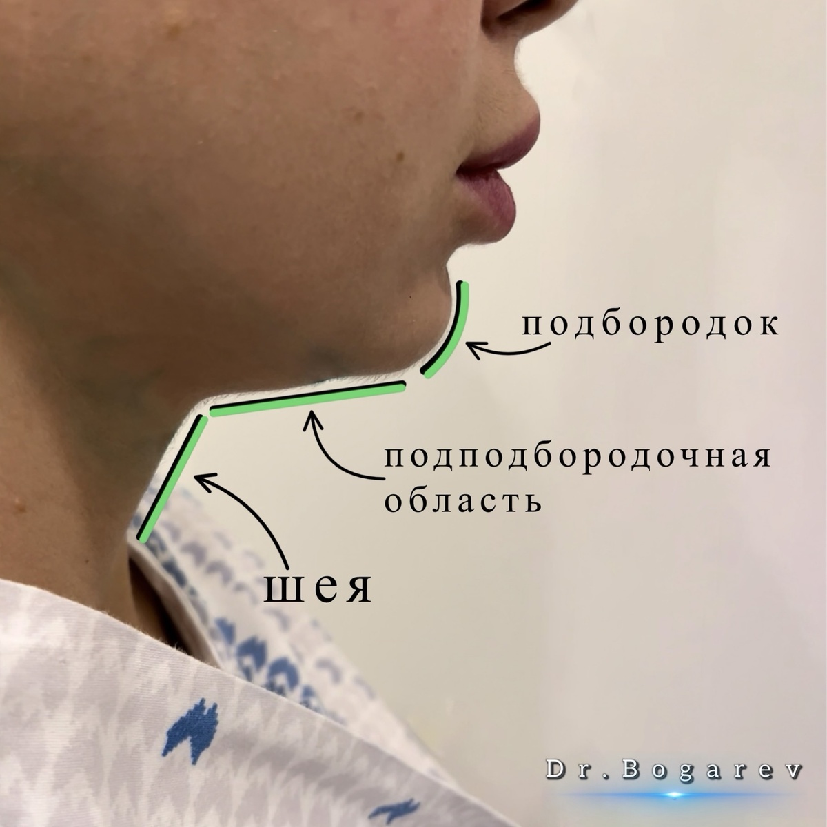 Границы подбородка заканчиваются у нижнего края нижней челюсти. Область, которая находится ниже (в проекции дна полости рта), называется подподбородочная область.