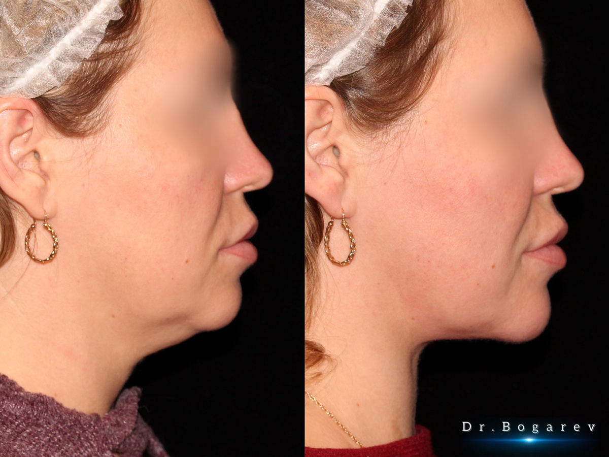 Результат комплексной платизмопластики через год после операции. Пластический хирург Александр Богарев.