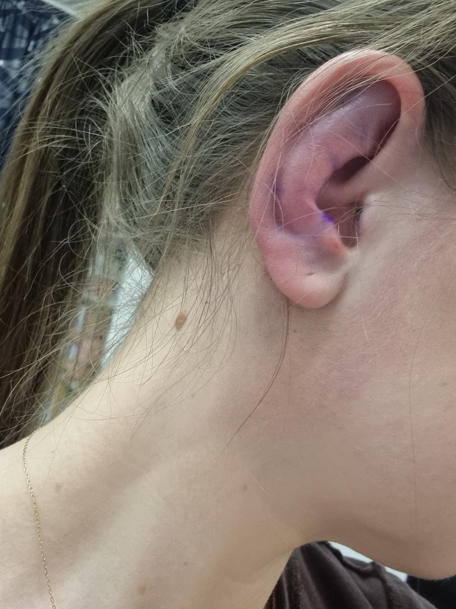 Ухо на следующий день после операции 