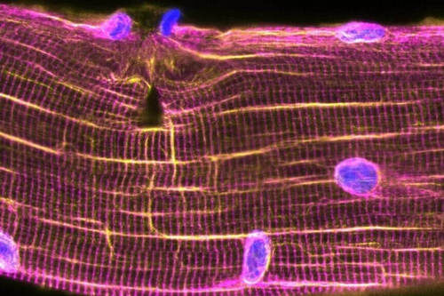 Микроповреждения в мышцах 