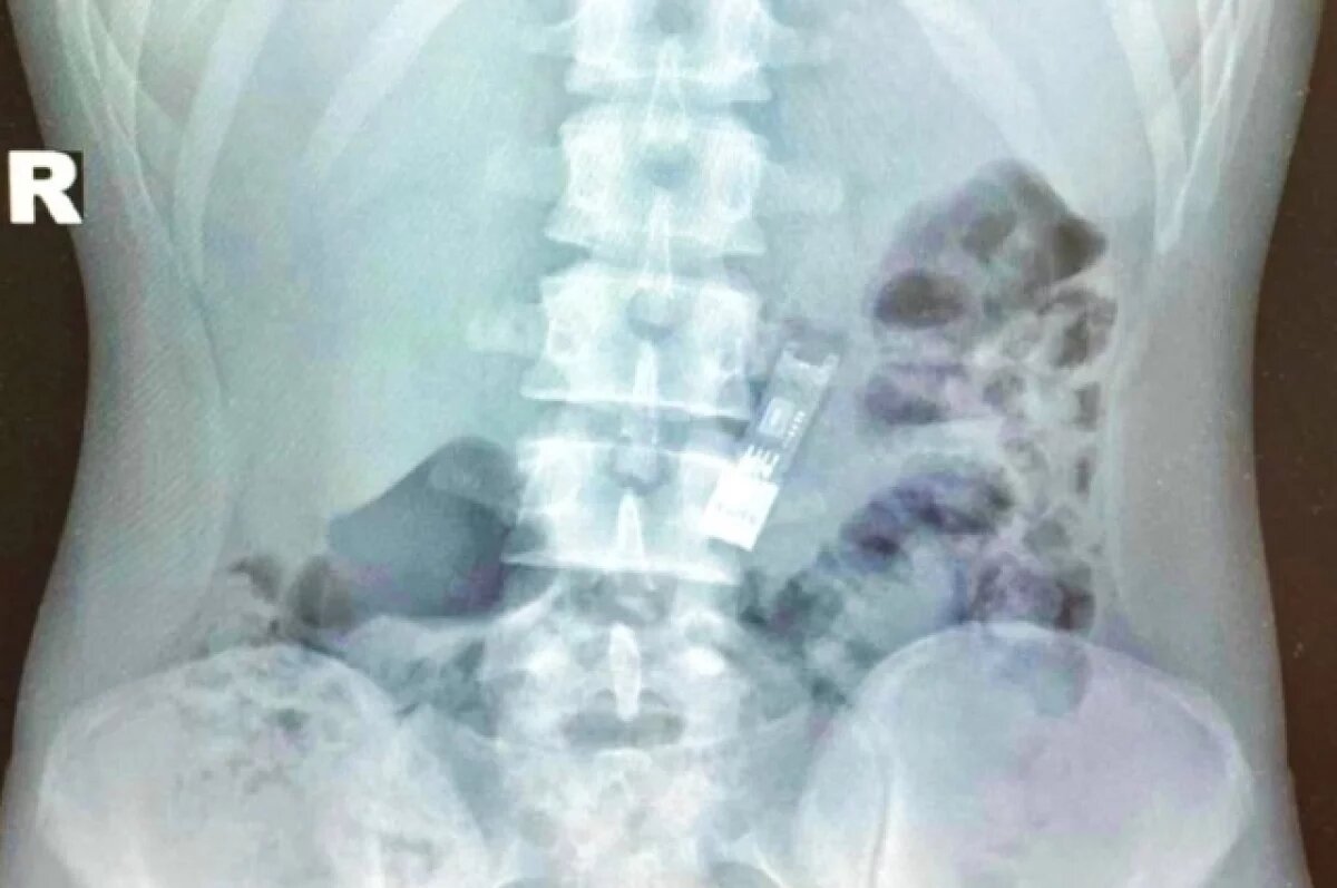    В Подмосковье школьник проглотил флешку с домашним заданием