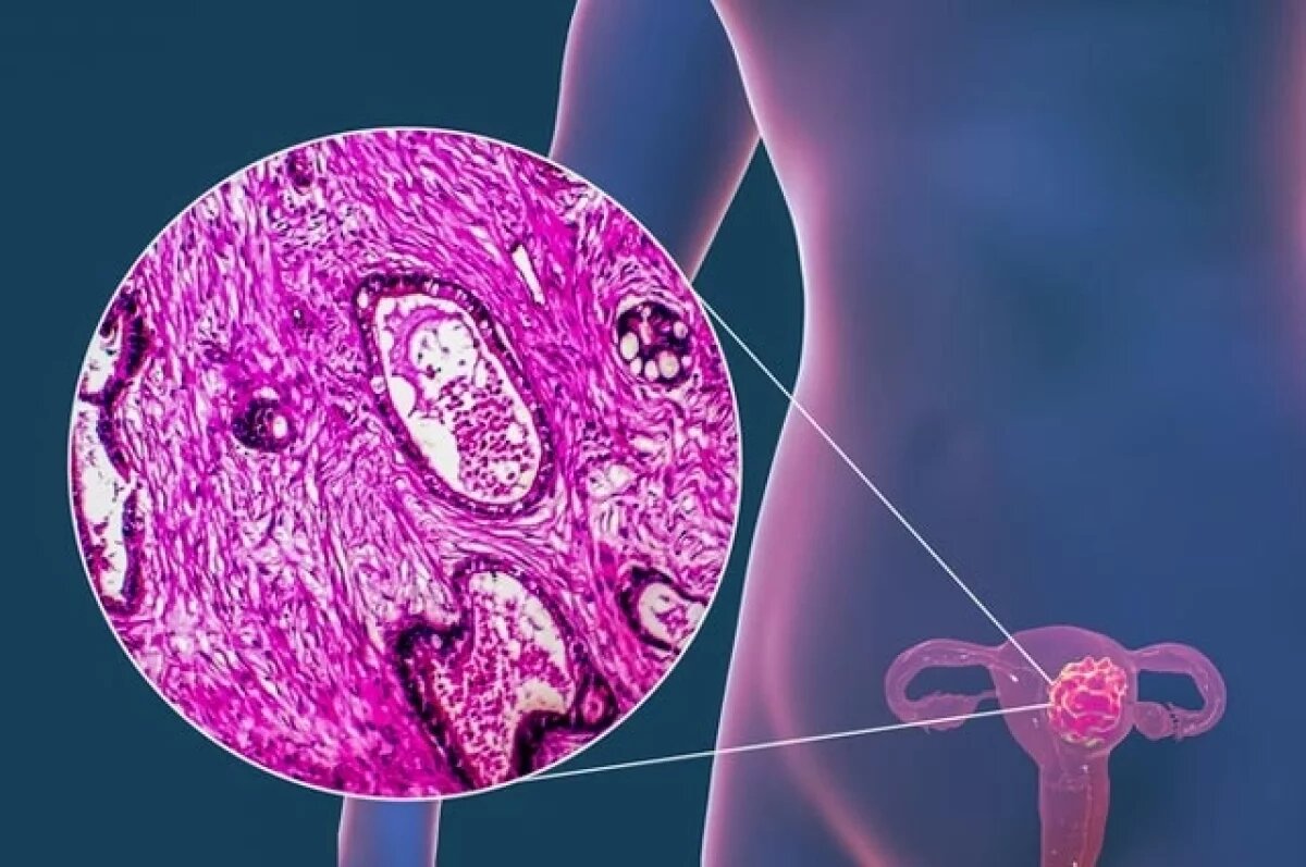    Гинеколог Назарова рассказала, как вовремя распознать рак шейки матки