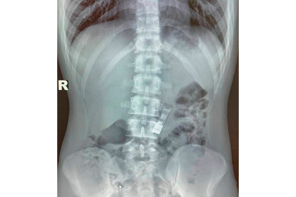 roshal_kids / Telegram📷Столичные врачи извлекли из желудка подростка флешку с домашним заданием