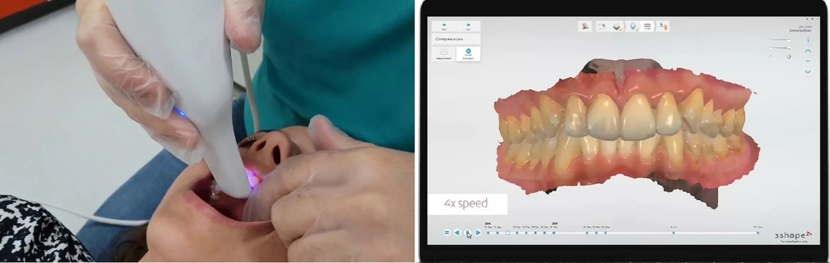Снятие оттиска с помощью внутриротового 3d сканера