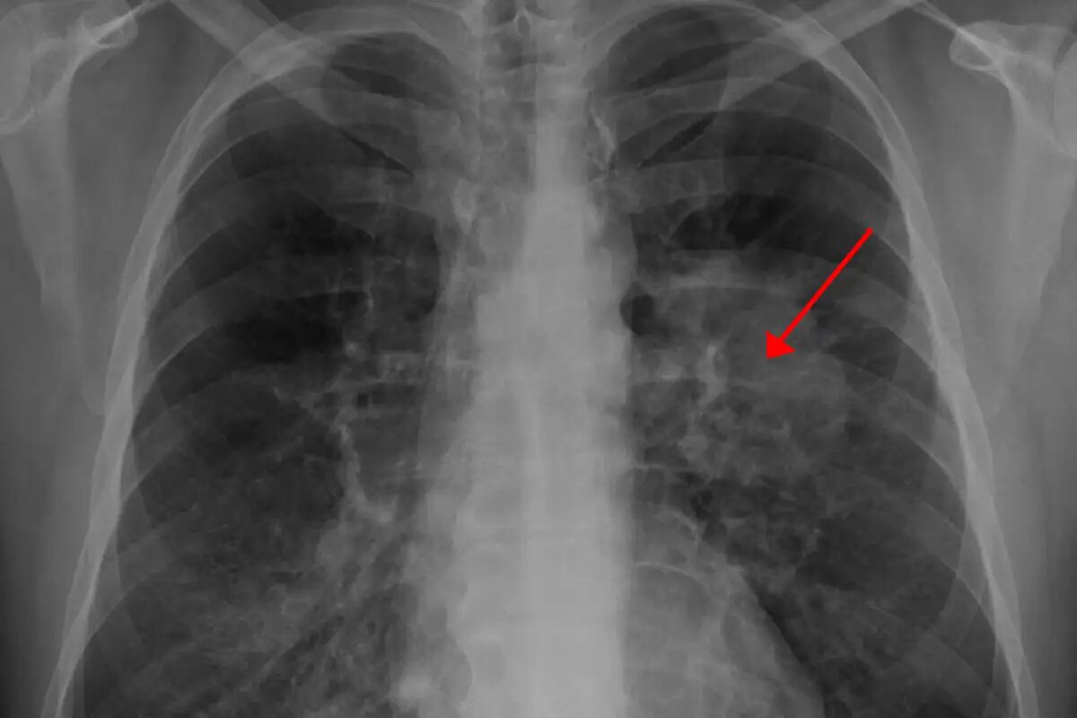    Рентгенограмма грудной клетки, демонстрирующая опухоль в лёгких. © ru.wikipedia.org