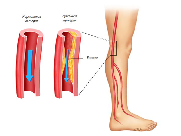 Сравнение здорового и поражённого атеросклерозом сосуда.