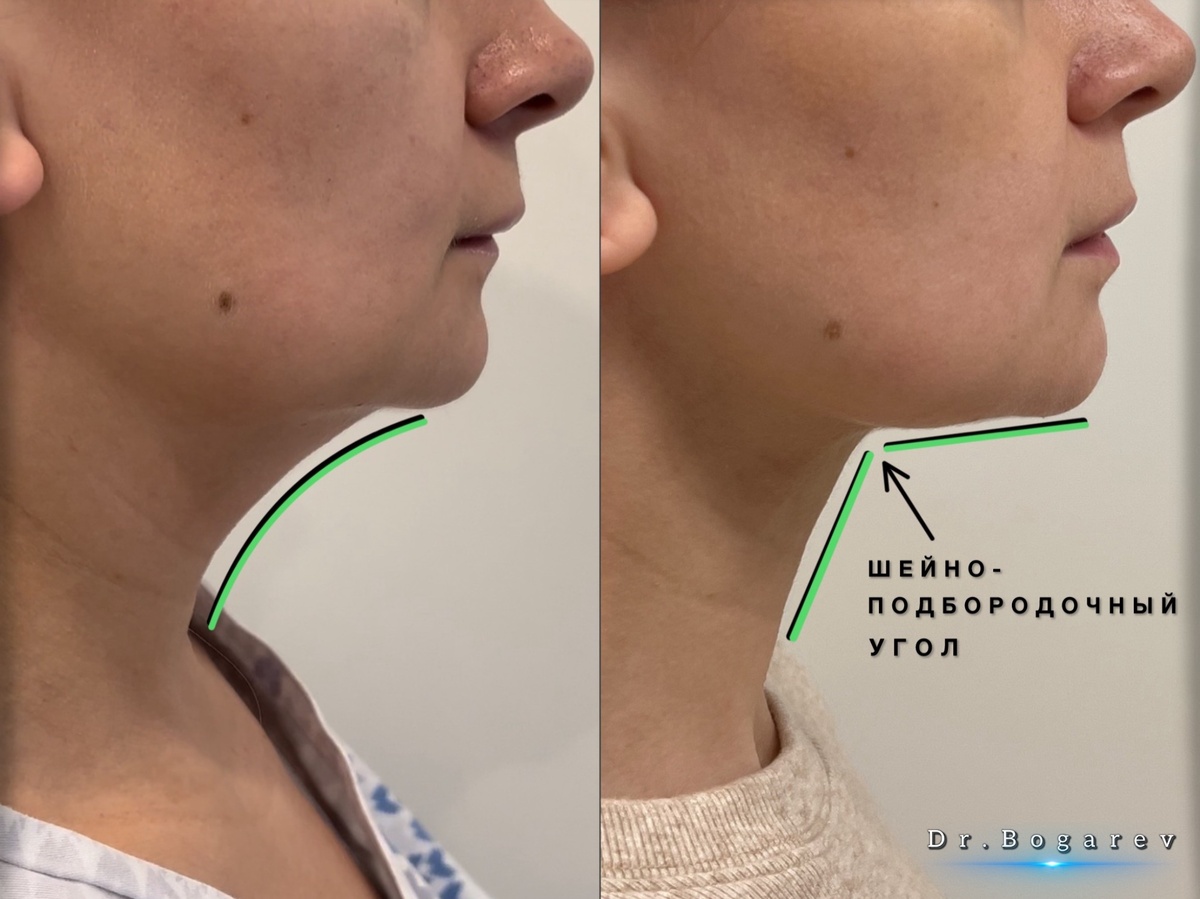 Шейно-подбородочный угол – угол образуемый в месте перехода линии подподбородочной области к вертикальной линии шеи. Результат комбинированной пластики шеи. Пластический хирург Александр Богарев.